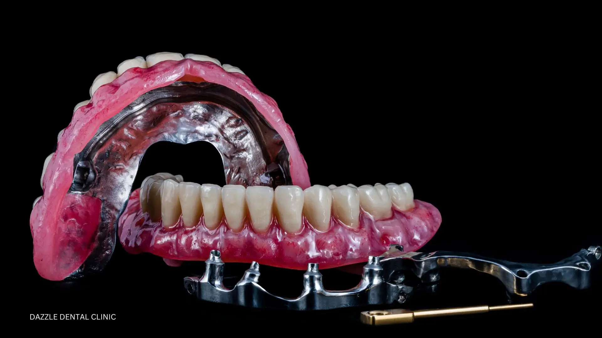 All On 4 Implants Vs Implant Supported Overdenture Vs Dentures Which